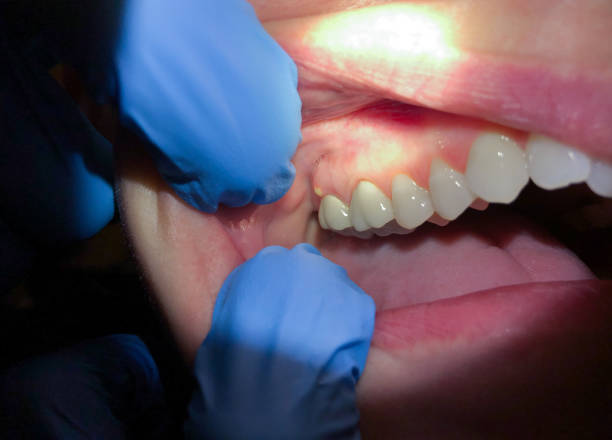 Best Cosmetic Emergency Dentistry in West Elmira, NY